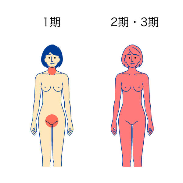 梅毒 女性