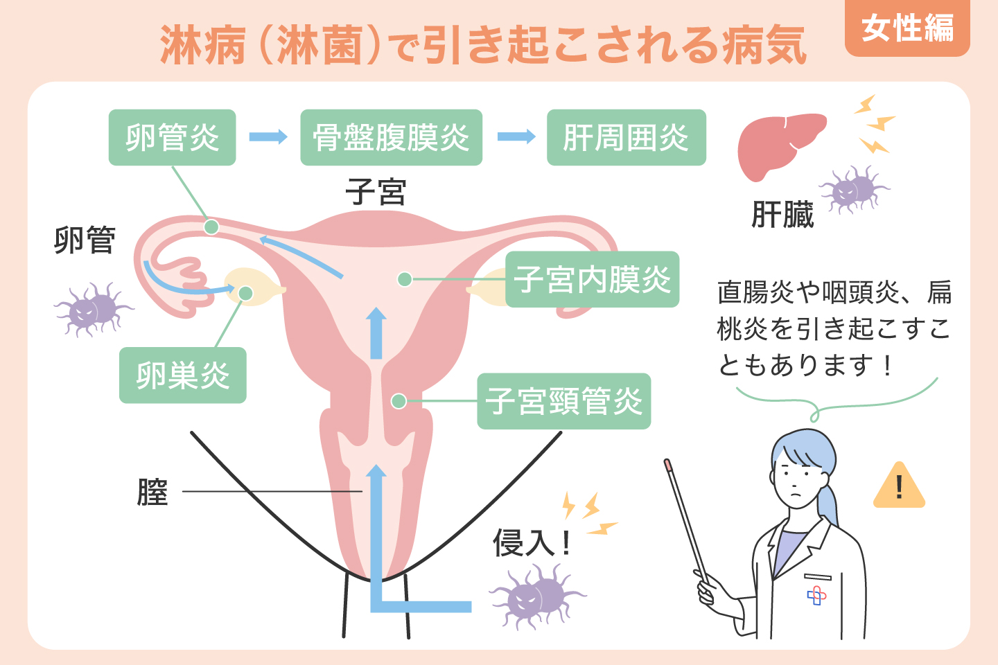 淋病（淋菌）で引き起こされる病気